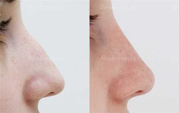 До и после. Безоперационная ринопластика