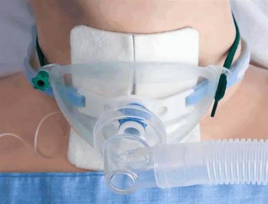 Искусственная вентиляция легких через трахеостому – отверстие в трахее