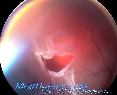 травма сетчатки