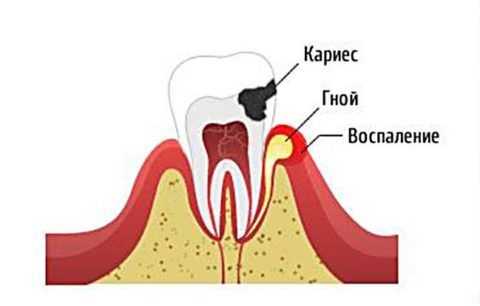 Одонтогенный путь передачи