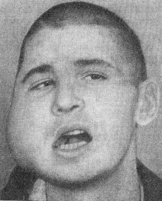 Поражение нижней челюсти