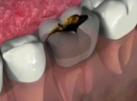 Гнойный периодонтит нижней челюсти