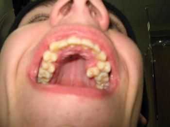 Подострая стадия остеомиелита