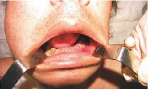 Диффузный остеомиелит нижней челюсти