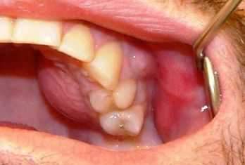 Острая стадия остеомиелита