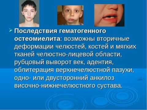 Последствия гематогенного остеомиелита