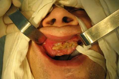 Фото: Внешние симптомы остеомиелита