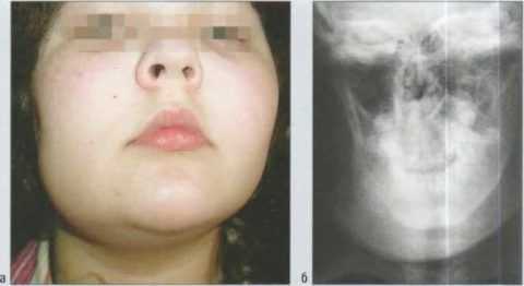 Возникновение остеомиелита нижней челюсти