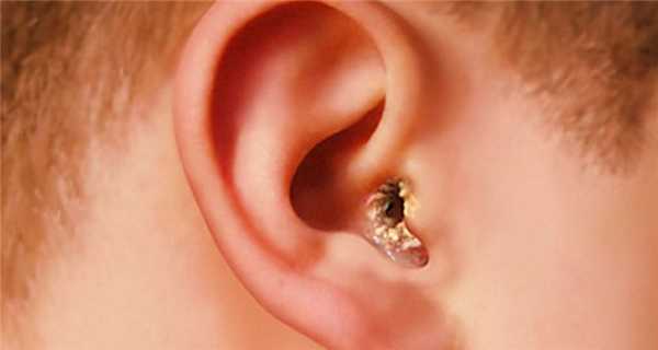 НАРУЖНЫЙ НЕКРОТИЧЕСКИЙ (ЗЛОКАЧЕСТВЕННЫЙ) ОТИТ.jpg