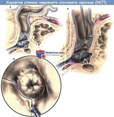 Этапы операции при стенозе наружного слухового прохода