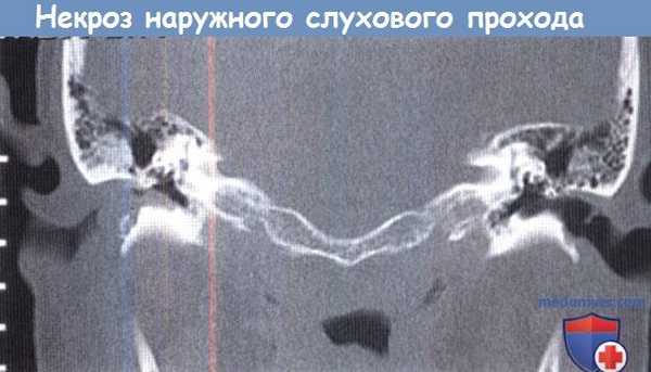 Некроз наружного слухового прохода