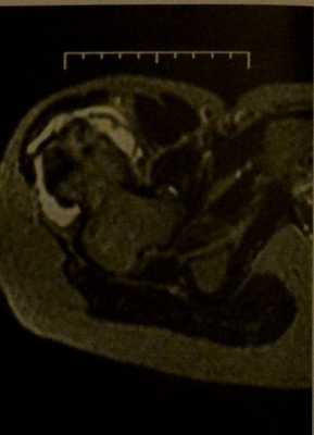 Снимки МРТ и КТ. Остеохондрома (костно-хрящевой экзостоз)