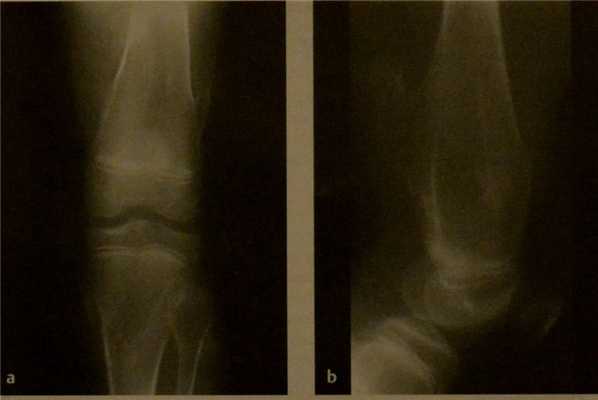 Снимки МРТ и КТ. Остеохондрома (костно-хрящевой экзостоз)