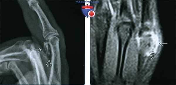 Необычная паростальная остеохондроматозная пролиферация - лучевая диагностика