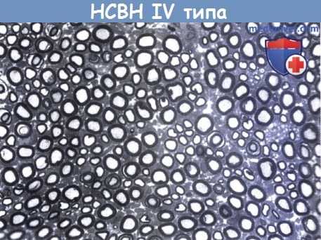 Наследственная сенсорная и вегетативная невропатия (НСВН) IV типа (врожденная нечувствительность к боли с ангидрозом)