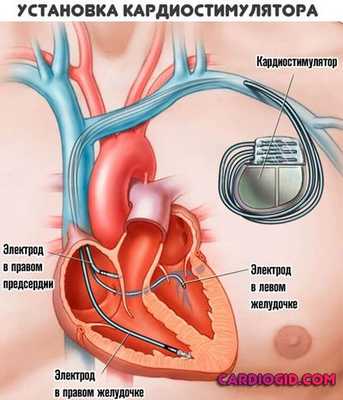 кардиостимулятор