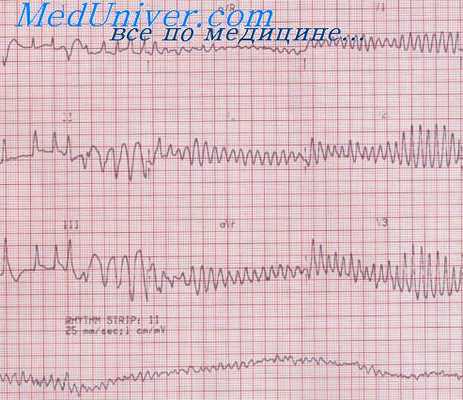 Фибрилляция желудочков на ЭКГ