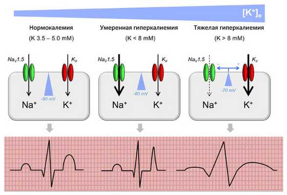 Степени гиперкалиемии