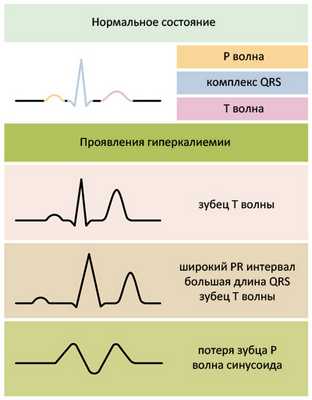 ЭКГ-признаки гиперкалиемии