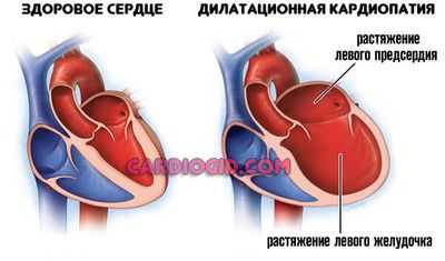 дилатационная кардиомиопатия
