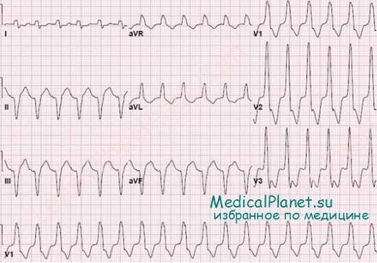 Желудочковая тахикардия на ЭКГ