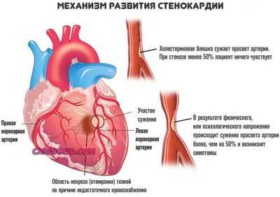 развитие-стенокардии