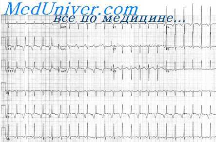 ЭКГ при пароксизмальной наджелудочковой тахикардии