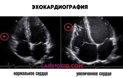эхокардиография сердца