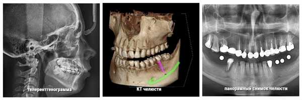 Снимки челюсти разными способами