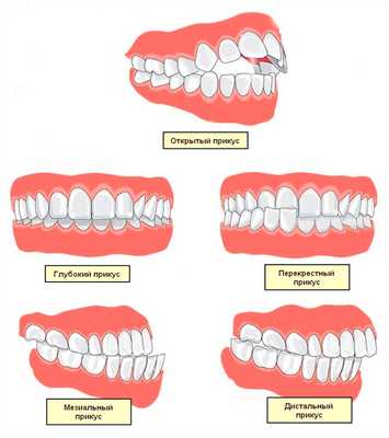 Иллюстрация базовых типов нарушения прикуса