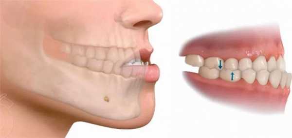 Неправильный прикус