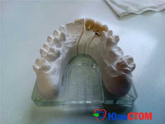 Зубные протезы