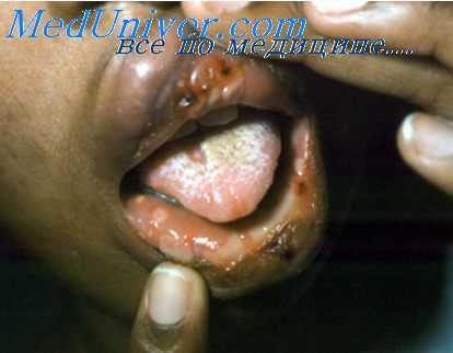 протезное ложе