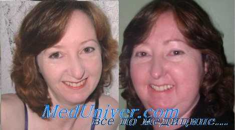 болезнь Кушинга - лечение