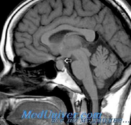 пролактинома