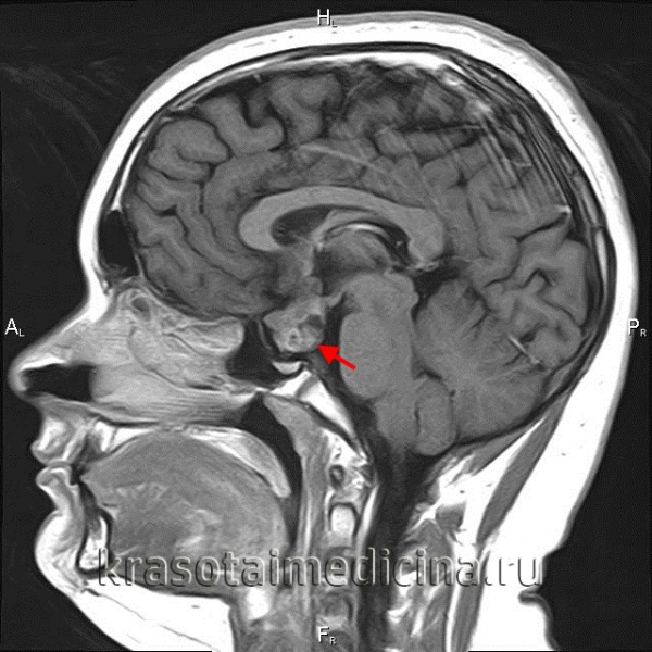 МРТ головного мозга. Не полностью удаленная аденома гипофиза