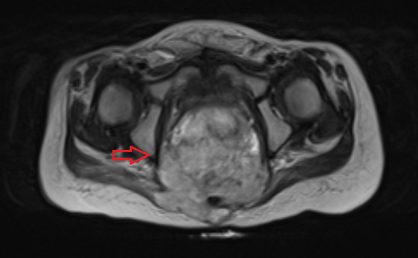 Крестцово-копчиковая тератома у ребенка 2-х лет (МРТ).