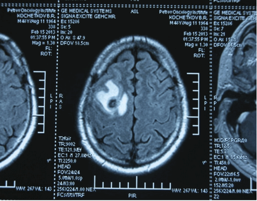 Метастаз в головной мозг при герминогенной опухоли