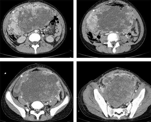 КТ органов брюшной полости - опухоль яичника