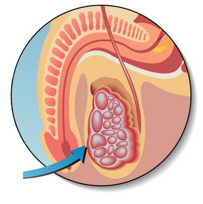 Герминогенные опухоли