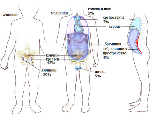 Лимфома средостения