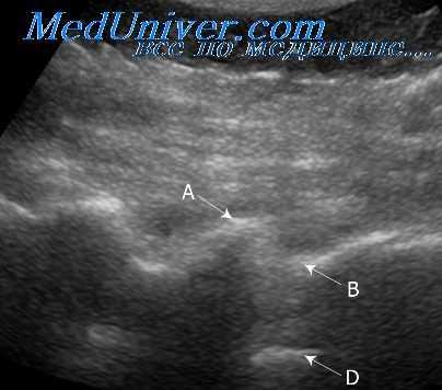 несовершенный остеогенез