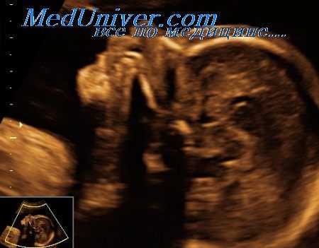 несовершенный остеогенез