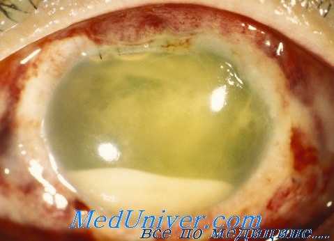 антибиотики при эндофтальмите