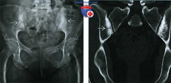 Конденсационный остеит - лучевая диагностика