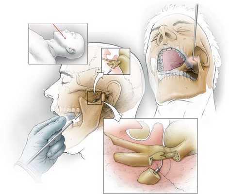 Невротомия