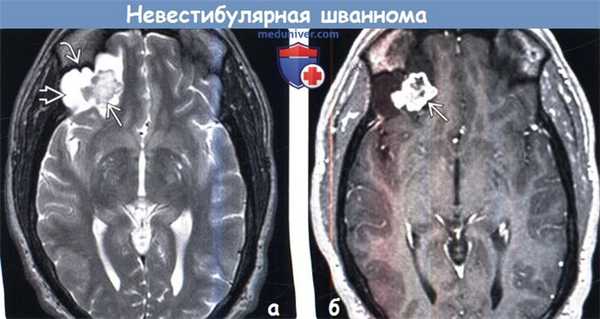Невестибулярная шваннома на МРТ