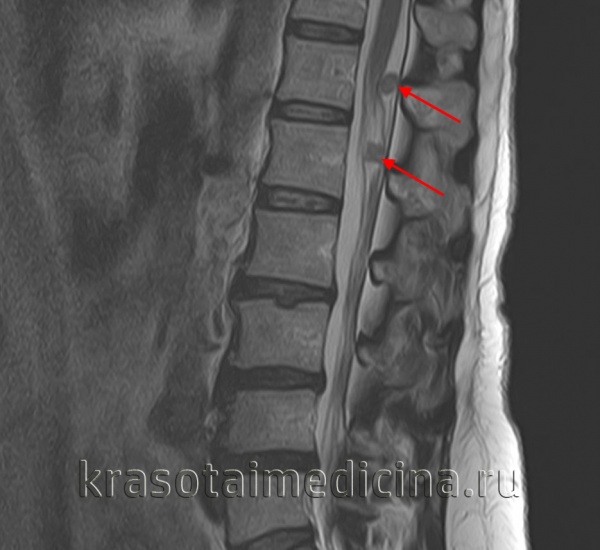 Метастатические опухоли мозга