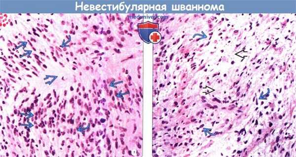 Гистология (морфология) невестибулярной шванномы