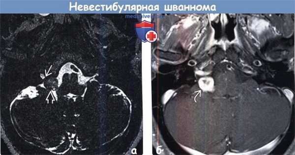 Невестибулярная шваннома на МРТ